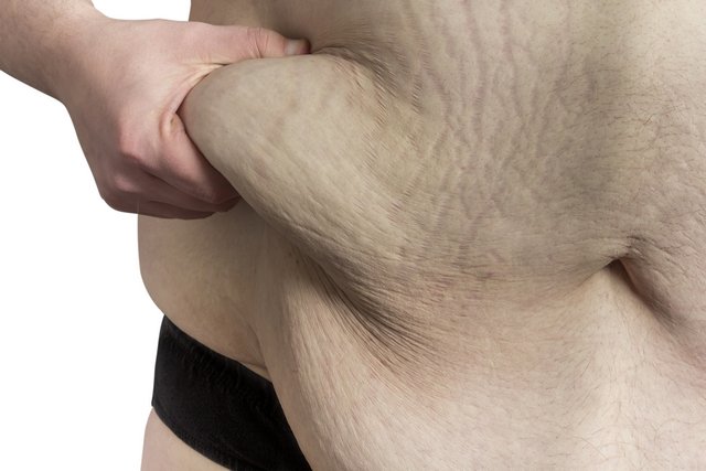 superfunds for body contouring after weight loss bariartic surgery