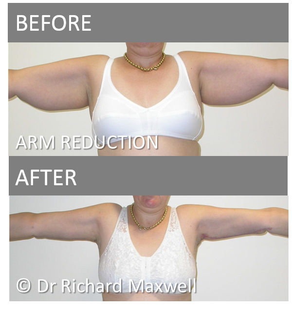 Breast Lift Without Implants After Weight Loss